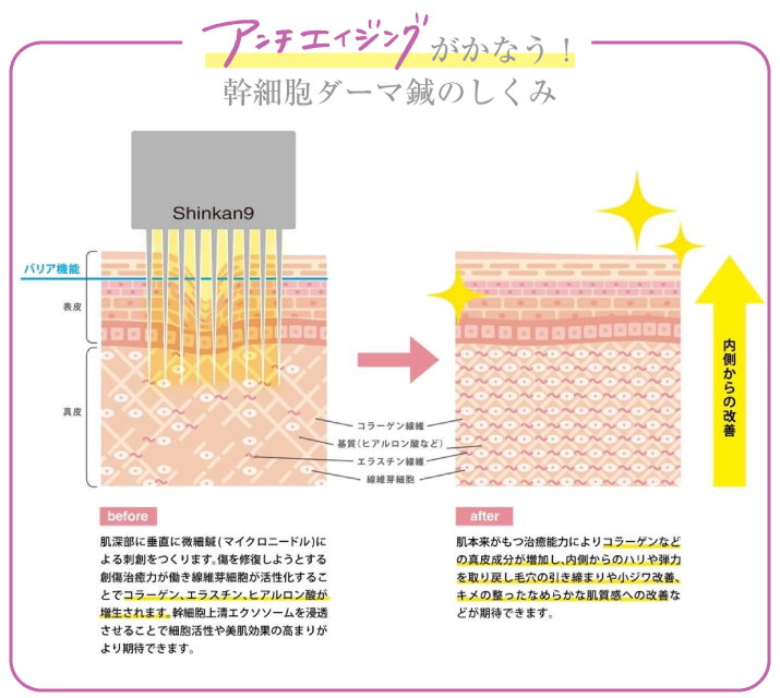 アンチエイジングがかなう！幹細胞ダーマ鍼のしくみ