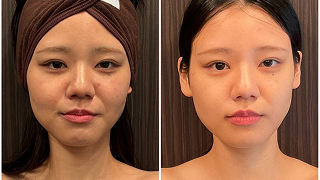 ダウンタイム・出血・赤みほぼ無し