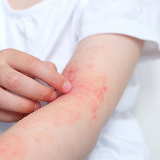 アトピー性皮膚炎症状の改善