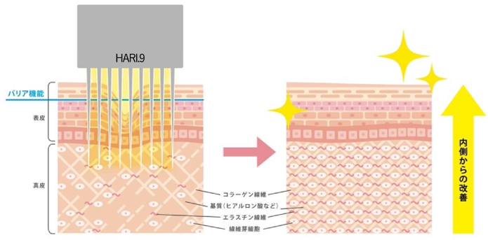 幹細胞ダーマ鍼のしくみ